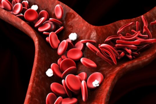 Common Myths and Misconceptions About Sickle Cell